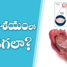 Home Remedies For Ovarian Cyst | Health Tips In Telugu | Manthena Satyanarayana Raju Videos