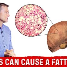 Can a Ketogenic Diet Cause Fatty Liver Disease? – Dr.Berg