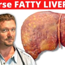 How Fast can KETO Reverse Fatty Liver? (Reverse NAFLD Fast)